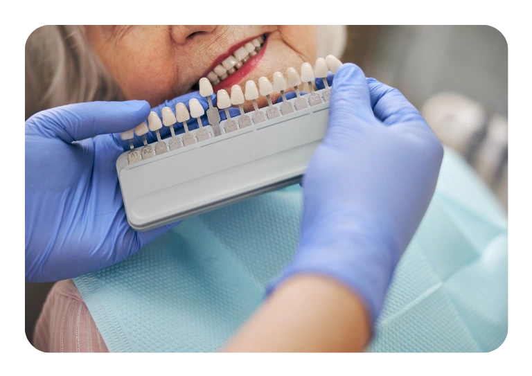 Seleção de cor para facetas dentárias