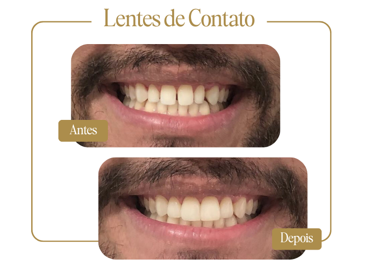 Lentes de Contato - Antes e Depois