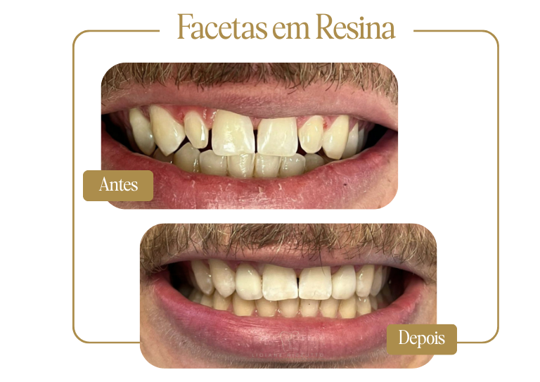 Facetas em Resina - Antes e Depois