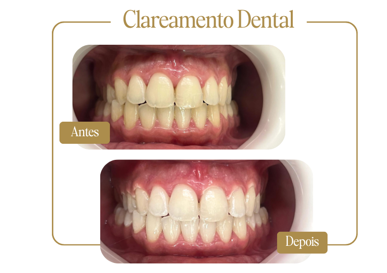 Clareamento Dental - Antes e Depois