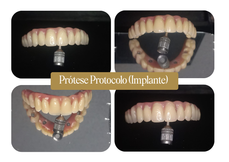 Prótese Protocolo (Implante)