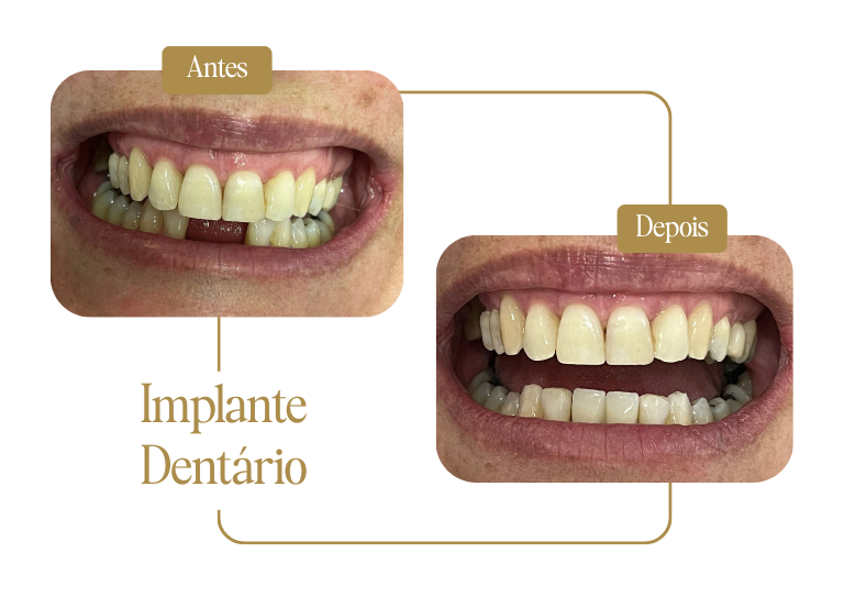 Antes e depois de implante dentário