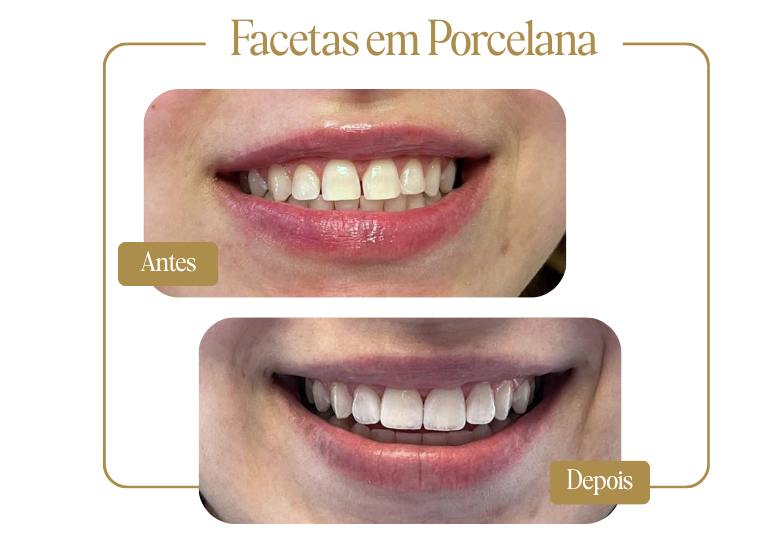 Facetas em Porcelana - Antes e Depois